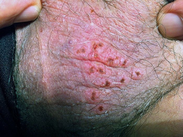 Herpes Hsv 2 Infection