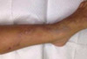 Creeping Eruption-Cutaneous Larva Migrans