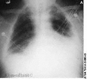 Myxedema Heart
