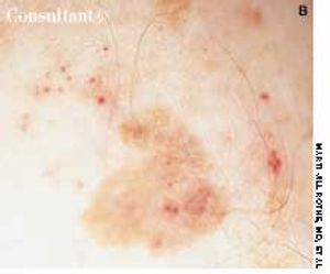 Pigmented Bowen's Disease