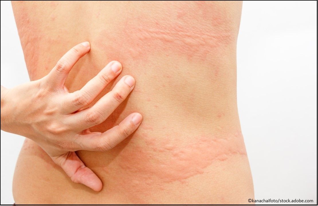 Quzyttir (cetirizine hydrochloride) Injection, hives, Urticaria