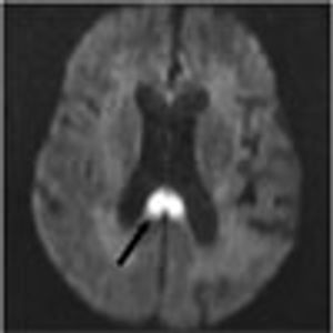 Bilateral Alien Hand Syndrome