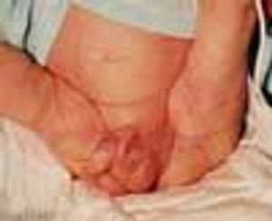 Arthrogryposis Multiplex Congenita
