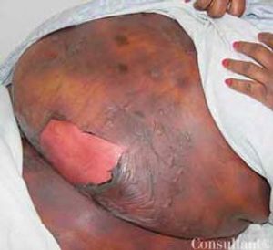 Toxic Epidermal Necrolysis