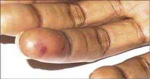 Osler Nodes