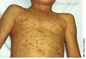 Urticaria Pigmentosa