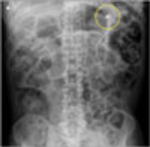 Foreign-Body Ingestion in a Man With Parkinson Disease Dementia