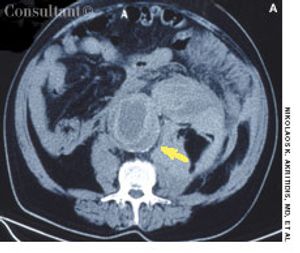 Ruptured Aortic Aneurysm