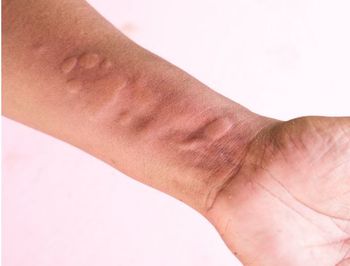 FDA Accepts Dupilumab sBLA for Review for Treatment of Chronic Spontaneous Urticaria / Image credit: ©chomplearn 2001/AdobeStock