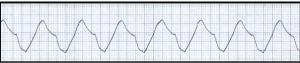 A Wide, Slow Cardiac Rhythm in a Lethargic Patient