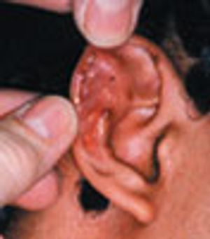 Gouty Tophi of the Pinnae