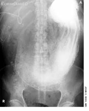 Gastric Outlet Obstruction Following Treatment for Cholangiocarcinoma