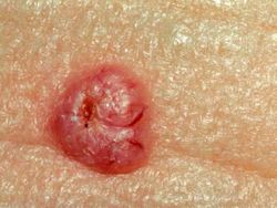 FDA Approves Drug for Basal Cell Carcinoma