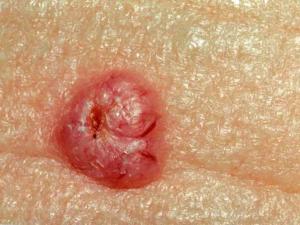 Basal cell carcinoma (Medpagetoday.com)