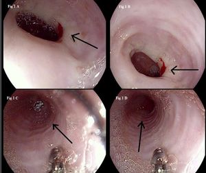 Trachealization of the Esophagus