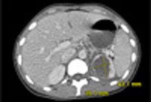 Renal Abscess Caused by Klebsiella Pneumoniae