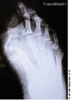 Tuberculous Arthritis