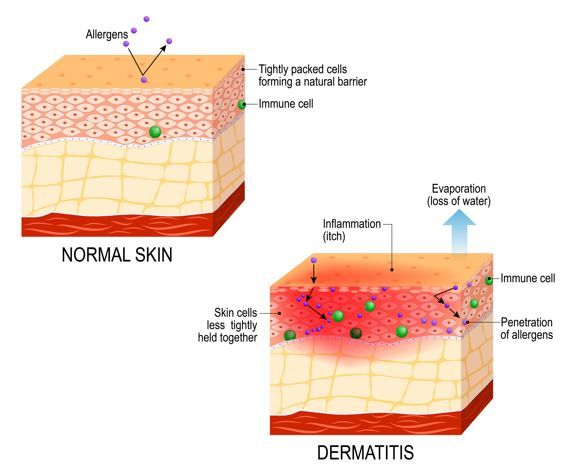 5 Novel Mechanisms Reshaping Atopic Dermatitis Treatment / image credit ©designua/stock.adobe.com
