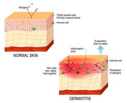 Evommune Launches Phase 2b Trial of Oral MRGPRX2 Antagonist, EVO756, In Adults With Atopic Dermatitis 