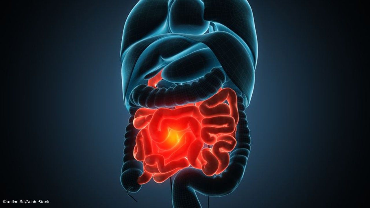 Crohn disease: Guselkumab (Tremfya) injection, a selective interleukin-23 inhibitor, was awarded a label expansion to include the treatment of adults with moderately to severely active Crohn disease