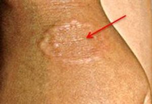 A Ring of Firm Multiple Papules 