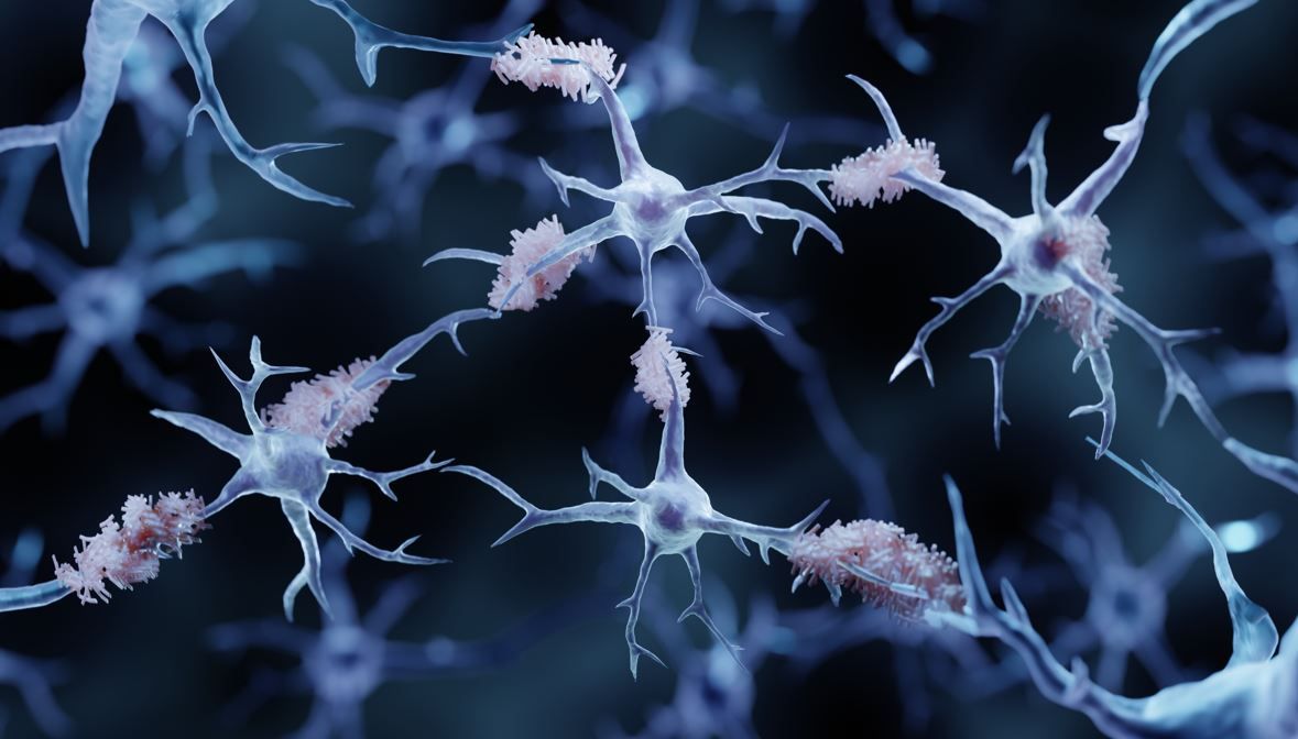 Lecanemab Shows Sustained Benefit at 4 Years in Early Alzheimer Disease: AAIC 2025 / Image credit: ©Artur/AdobeStock