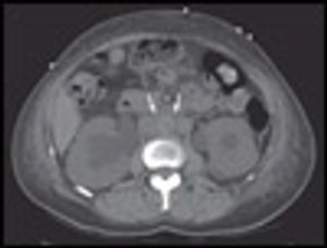 Retroperitoneal Fibrosis