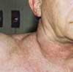 Hilar Mass with Venous Encroachment