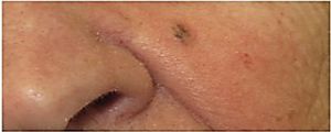 Three Suspicious Lesions on an Elderly Woman's Face