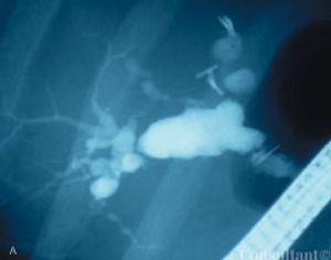 Cholangitis Caused by Parasitic Infection