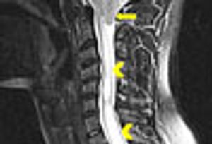 Chiari I Malformation in a Young Man With Persistent Neck Pain