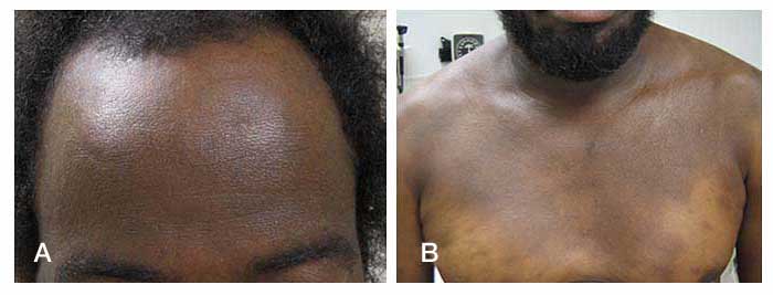 hiv rash on chest black people