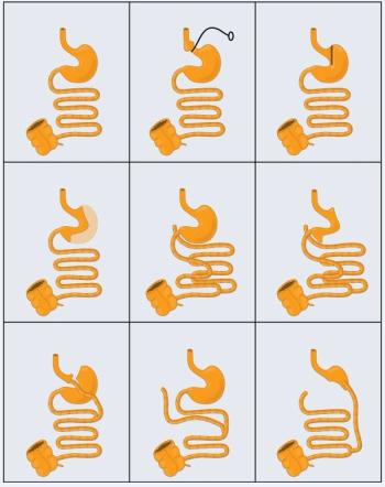 Liraglutide Safe and Effective Treatment for Weight Regain after RYGB Surgery, Study Suggests