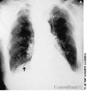 Foramen of Bochdalek