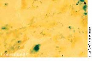 Sideroblastic Anemia