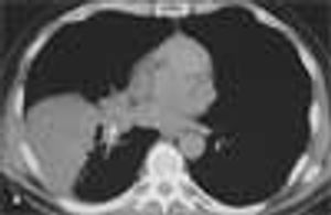 Lung Incidentaloma