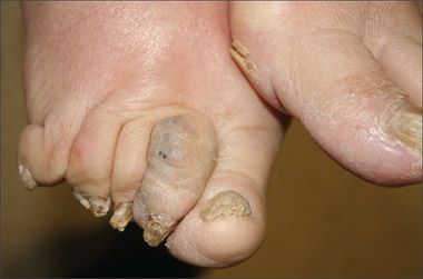 An Old Woman With A Very Different Purple Toe An Old Woman With A Very Different Purple Toe