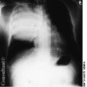 Right Upper Lobe Consolidation Simulating Pulmonary Neoplasm