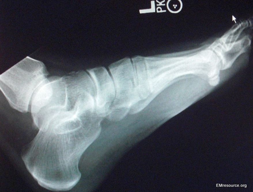 Foot Fault Can You Find the Injury? Patient Care Online