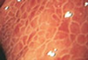 “Snakeskin” Gastric Mucosa