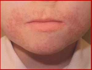 Rash Around the Mouth of a 5-year-old Child