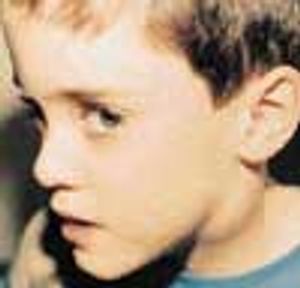 Atypical Mycobacterial Lymphadenitis