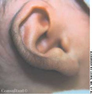 Hypertrichosis Pinnae and Maternal Diabetes Mellitus