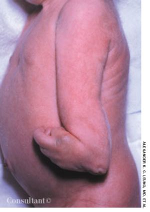 Trisomy 18 (Edwards Syndrome)
