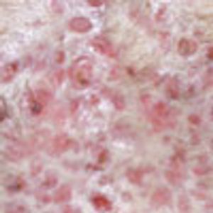 Acne Conglobata