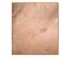 Shiny Pink Nodule on Malar Cheek 