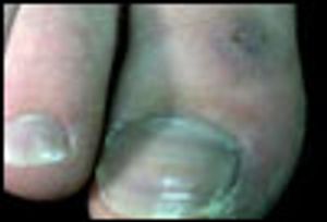 Idiopathic Chilblains