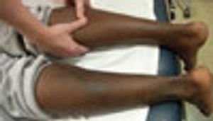 Photo Dx: Achilles Tendon Rupture? Tendonitis? Bursitis? Something Else?
