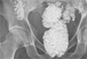 Lithophagia
