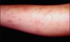 African American Woman With Bilateral Ankle Pain And Nodular Rash On Shins Hepatitis Strep Infection Gonorrhea Sarcoidosis African American Woman With Bilateral Ankle Pain And Nodular Rash On Shins Hepatitis Strep Infection Gonorrhea Sarcoidosis